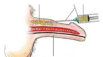 Surgical methods to enhance members