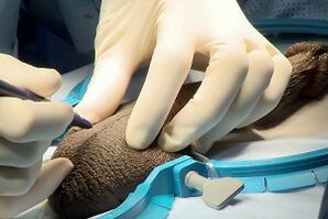 Incision Midge for penis enlargement surgery